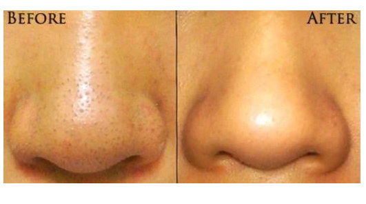 Pore Cleanser & Blackhead Remover