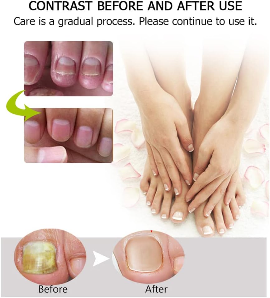 Nail Repair - Nail Treatment Repair Gel (Renews Yellow, Cracked, Damaged Nails)