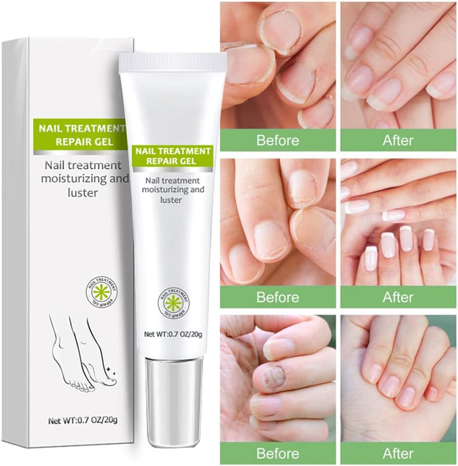 Nail Repair - Nail Treatment Repair Gel (Renews Yellow, Cracked, Damaged Nails)